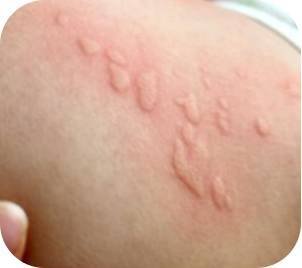 皮肤一抓就起疙瘩？别慌！可能是身体在给你发“求救信号