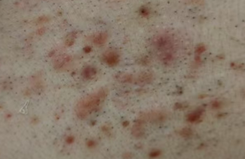 毛囊炎指南:这些症状和护理误区，你中招了吗?