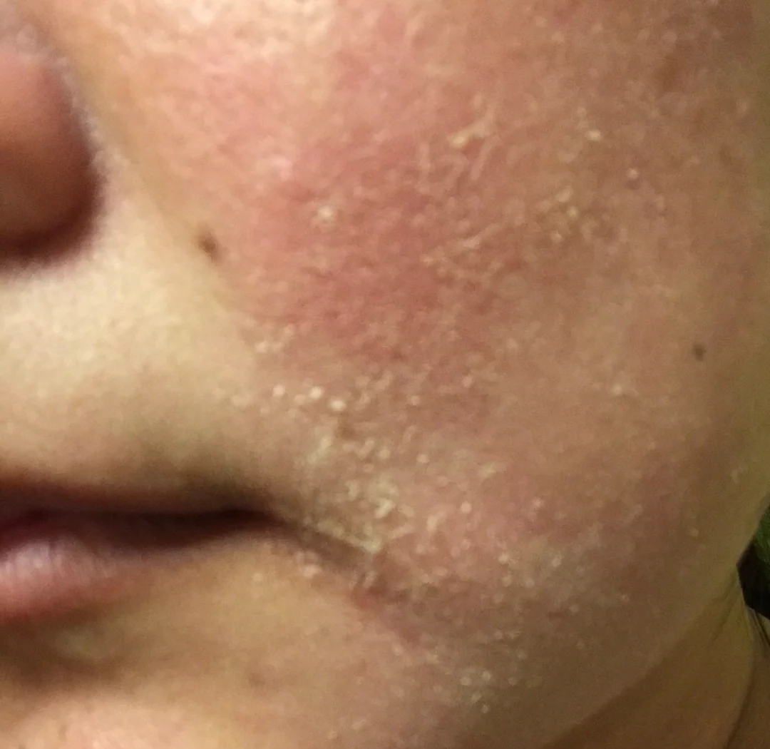 冬天脸又痒又痛？你的皮肤正在发出“求救信号”！