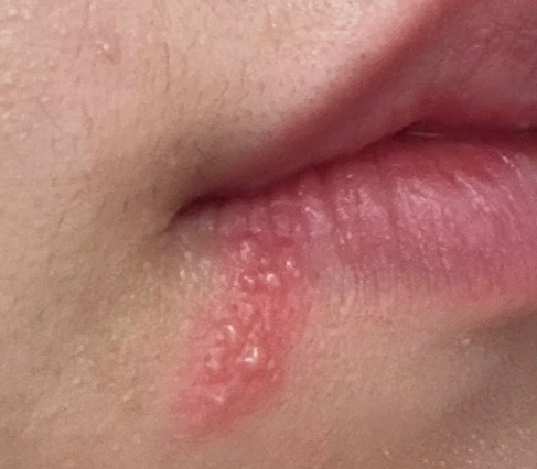 嘴角起疱疹？别慌！可能是这些“小调皮”在作怪