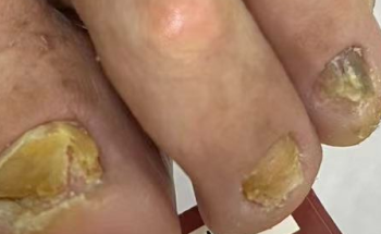 灰指甲不是"灰"的错！这些真相让你大吃一惊