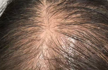 掉发自救指南：你的头发在“求救”的5个信号！