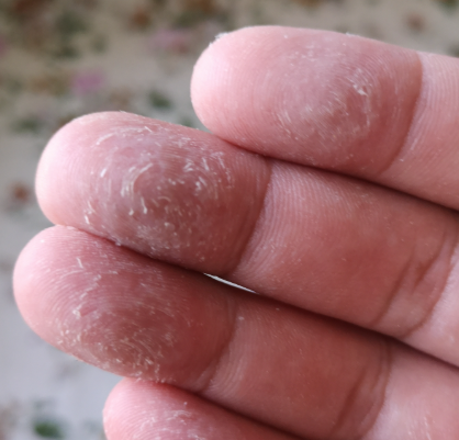 手指总脱皮？这些隐藏原因你可能从未想过！