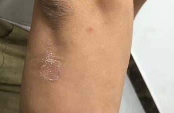 皮肤“闹脾气”？可能是特应性皮炎在作怪！