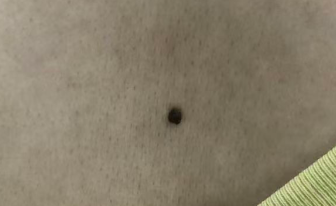  身上这颗痣是“定时炸弹”还是普通印记？3分钟教你一眼辨清！