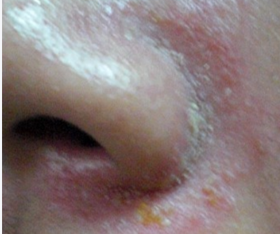 鼻子两侧反复泛红脱屑？警惕脂溢性皮炎