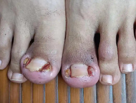 脚趾头肿成“小馒头”？甲沟炎自救指南来啦！