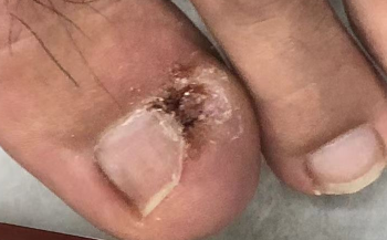 发现得了甲沟炎？这样处理更稳妥