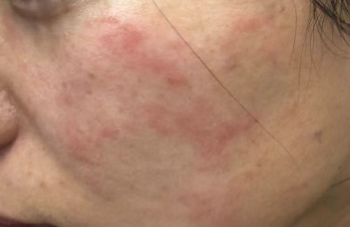 过敏引发全脸脱皮，正确护理促恢复