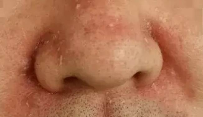 夏季脂溢性皮炎护理 科学护肤远离反复炎症