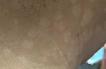 汗斑饮食注意事项 饮食调理减少复发