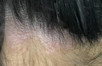 脂溢性皮炎头屑多？科学助你改善头皮状态