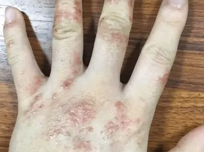 手上起水泡湿疹，正确护理方式科普