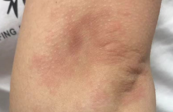 频繁起荨麻疹发痒？其实是身体内部发出预警