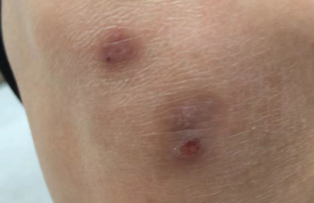 湿疹不止一种！常见湿疹类型及特点科普
