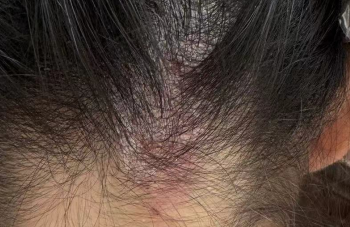 头皮脂溢性皮炎如何护理？完整日常养护指南