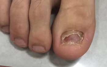 指甲空了是不是灰指甲？别再盲目混淆