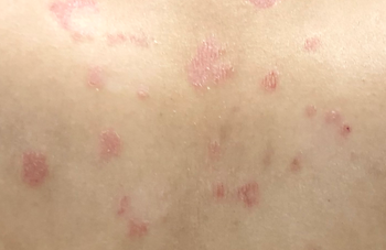 牛皮癣多久能好？恢复周期与日常养护科普