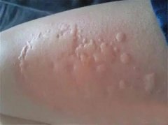 珠海荨麻疹的类型症状
